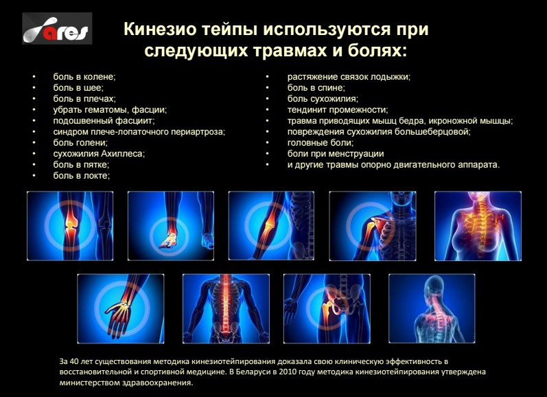 При яких травмах і болях використовуються кінезіотейпи При яких травмах і болях використовуються кінезіотейпи
